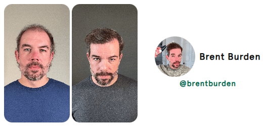 hair loss hair loss reversal natural hair loss reversal receding hair line hair growth natural hair growth hair growth remedy hair loss treatment nutrafol for women hair growth serum nutrafol for men alopecia areata alopecia hair regrowth for men rogaine for women rogaine for men best hair loss treatment hair growth shampoo keeps hair loss hims hair shampoo for hair loss beard growth dht blocker hair loss in women hair regrowth hair loss treatment for men hair doctor near me hair restoration near me hair regrowth for women best hair growth serum beard roller best shampoo for hair loss viviscal pro hair loss treatment for women hair specialist near me hair fall treatment hims hair growth best hair regrowth for men hair growth treatment thinning hair women best shampoo for hair growth vegamour hair serum hims hair loss nutrafol hair growth trichologist near me viviscal hair growth allurium hair growth serum thinning hair vegamour gro hair serum keranique hair regrowth treatment best hair loss treatment for female receding hairline postpartum hair loss hair growth for men hair clinic near me nutrafol hair hair implants for women bondi boost shampoo roman hair loss best hair regrowth for women hair regrowth treatment hair thinning treatment best hair loss treatment for male hair treatment for hair loss regrow hair naturally in 3 weeks best shampoo for hair loss female hair growth for women trichologist hair growth serum for women for hims hair capillus laser cap receding hairline treatment keeps hair treatment dermatologist recommended shampoo for hair loss hair loss prevention hair specialist doctor near me nutrafol women's balance hair transplant for women hair specialist nourishvita hair best shampoo for hair fall bondi boost hair growth female hair loss treatment mens hair loss hair falling out dermatologist hair loss specialist near me hair loss specialist near me best hair loss treatment for men hairfall solution hairmax laserband best hair serum for hair growth thinning hair men hair replacement for women moerie hair growth female hair loss hair fall control telogen effluvium best hair loss treatment for women hair loss doctor near me best hair growth male pattern baldness hair loss shampoo for men best hair regrowth treatment keeps hair loss treatment viviscal for women hair regrowth shampoo keranique hair regrowth hair loss clinic near me hair restoration for men keeps hair growth hair serum for hair growth hair loss cure hair loss serum laser cap for hair growth hair loss treatment near me male hair loss treatment kiierr laser cap hims hair regrowth treatment viviscal hair hair regrowth serum natural hair growth products hair loss clinic stop hair loss moerie hair shampoo for hair loss women viviscal shampoo hair loss doctor grow gorgeous hair growth serum hair growth treatment for women nutrafol for hair growth male pattern baldness treatment dermatologist for hair loss near me receding hairline men beard growth serum nutrafol hair growth serum hair growth treatment for men itchy scalp and hair loss vegamour hair growth serum hair treatment for men hair restoration for women dht blocker for women folexin hers hair growth keranique hair regrowth treatment for women hers hair regrowth treatment him hair loss best serum for hair growth and thickness bosley hair loss best hair growth for men best hair growth for women spectral dnc grow hair fast hair thinning treatment female laser hair growth hair growth serum for men neofollics shampoo hair plugs for women best treatment for thinning hair female best hair growth serum for women hair growth shampoo for men nutrafol hair growth supplement scalpmed for women spectral dnc n balding treatment nutrafol growth activator revivogen hims finasteride revivagen nutrifol for hims forhims topical finasteride finasteride 1mg finasteride for hair loss hims and hers buy finasteride finasteride tablets finasteride prescription hims finasteride finasteride 5mg 4hims oral finasteride finasteride online keeps finasteride finasteride pills buy finasteride online roman finasteride order finasteride hims sign in hims topical finasteride keeps topical finasteride cheapest finasteride propecia online finasteride for sale get finasteride prescription online finasteride cost finasteride for women order hims online order finasteride online finasteride hims hims products topical finasteride buy finasteride propecia generic finasteride finasteride hair growth finasteride over the counter finasteride online pharmacy best topical finasteride hims website bosley finasteride finasteride 1mg tablets buy propecia goodrx finasteride finasteride price happy head topical finasteride finasteride amazon hims hers buy topical finasteride finasteride keeps order propecia online get finasteride prescription hims finasteride cost get finasteride nutrifol men revivogen shampoo finasteride without prescription finasteride pills for hair loss finasteride 1mg amazon hims & hers cheapest finasteride online gethims finasteride hair cheapest way to get finasteride just for hims hims and hers health finasteride for men buy finasteride 1mg nutrifol for men finasteride hair regrowth get finasteride online xyon topical finasteride finasteride no prescription nutrifol for women order propecia finasteride 1mg price hims finasteride price finasteride goodrx hims for her buy finasteride 5mg topical finasteride amazon finasteride near me for hims sign in buy finasteride amazon finasteride cvs topical finasteride prescription topical fin for hims finasteride hims online cheapest topical finasteride buy finasteride for hair loss finasteride purchase finasteride roman numan finasteride 5mg finasteride best finasteride for hair loss roman topical finasteride hers and hims finasteride pharmacy best finasteride hims promo topical finasteride only finasteride for women's hair loss him finasteride finasteride 1mg online hims thick fix topical finasteride cost happy head finasteride topical finasteride for sale nutrifol women topical finasteride keeps hims official website hims and hers website hims men roman finasteride cost lemonaid finasteride for hims products oral finasteride for hair loss finasteride rx hims treatment www forhims hers hims finasteride walgreens finasteride medication finasteride receding hairline nutrifol reviews liposomal finasteride propecia finasteride 1mg hims health finasteride 5mg tablets topical finasteride for hair loss finasteride for sale online propecia prescription online hair loss tablets finasteride nutrifol shampoo hims amazon hims usa topical finasteride for women hair loss treatment finasteride finasteride for hair loss in female hims for women finasteride without doctor finasteride hairline topical finasteride online for hims topical finasteride topical finasteride hims finasteride for receding hairline buy finasteride tablets finasteride 0.5 mg finasteride how to get topical finasteride buy online finasteride prescription cost hims for hair forhims finasteride hims near me finasteride topical for hair loss finasteride cost per month finasteride hair treatment hims target sons finasteride finasteride and dutasteride finasteride reddit finasteride treatment finasteride for hair loss female finasteride 1mg prescription rogaine and finasteride liposomal topical finasteride finasteride 1mg for hair loss finasteride products finasteride 5mg price accord finasteride hims store finasteride discount propecia over the counter hims for sale cheapest finasteride 1mg hims healthcare revivogen md forhi cvs finasteride finasteride uses finasteride 6 months pharmica finasteride hims topical finasteride cost propecia hair growth blink health finasteride propecia buy online propecia price hims & hers health topical finasteride price male pattern baldness female pattern baldness alopecia hair loss treatment alopecia areata hair loss best hair loss treatment hair loss in women hair loss treatment for men hair loss treatment for women hair fall treatment hims hair loss best hair loss treatment for female best hair loss treatment for male hair treatment for hair loss hair loss prevention female hair loss treatment mens hair loss hair falling out hair loss specialist near me best hair loss treatment for men female hair loss hair fall control best hair loss treatment for women hair loss doctor near me hair loss clinic near me my hair is falling out hair loss cure hair loss treatment near me red light therapy for hair loss male hair loss treatment hair fall solution hair loss clinic stop hair loss hair loss doctor male pattern baldness treatment hair loss causes itchy scalp and hair loss him hair loss hair thinning treatment female balding treatment topical hair loss treatment hair fall hair loss after pregnancy hair loss prevention men hair loss specialist androgenic alopecia causes of hair loss in women alopecia areata causes hair fall doctor near me male hair loss hair loss solutions best hair treatment for hair loss olumiant for hair loss hair loss surgery hair thinning at front female alopecia areata self care hair loss solutions for men hair loss remedies best hair loss treatment for female home remedy reverse hair loss anti hair loss reasons for hair loss in women hair fall treatment near me bald spot on head bald spot treatment scalp treatment for hair loss hair thinning treatment male nioxin hair loss new hair loss treatment natural remedies for hair loss light therapy for hair loss olaplex hair loss my hair is thinning female male baldness treatment most effective hair loss treatment for hims hair loss hair fall treatment for women reasons for hair loss female pattern hair loss natural hair loss treatment pcos hair loss hair fall reasons in female best hair fall treatment keep hair loss female hair loss specialist near me hair loss help olumiant hair loss hair balding treatment best for hair loss stop hair loss women dermaroller for hair loss sudden hair loss in women dht hair loss stop hair loss men best thing for hair loss hair loss solutions for women hair transplant hair transplant cost hair transplant near me hair restoration hair restoration near me fue hair transplant hair implants hair replacement for men hair clinic near me hair implants for women hair plugs smile hair clinic hair implants for men cost beard transplant turkish hair transplant advanced hair restoration cost dhi hair transplant bosley hair transplant cost hair implants for men eyebrow transplant hair transplant for women hair replacement hair clinic hairline transplant hairline surgery fue hair transplant cost hair surgery best hair transplant hair replacement for women hairline restoration hermest hair clinic hair plugs cost hair transplant surgery hair plugs for men hair restoration for men hair implants near me hair transplant price hair restoration surgery hair replacement near me eyebrow hair transplant hair transplant consultation beard transplant cost mens hair transplant hair restoration for women fue hair transplant near me best hair transplant in the world bosley hair restoration cost hair plugs for women neograft hair transplant hair plantation cost non surgical hair replacement hairline transplant cost beard implants best hair restoration best hair doctor near me turkish hair transplant cost fut hair transplant stem cell hair transplant hair transplant clinic near me female hair transplant restore hair cost hairline lowering surgery hair follicle transplant cheap hair transplant hair plantation bosley hair replacement beard transplant near me hair implant cost hair restoration cost hair transplant clinic hair loss surgery 5000 grafts hair transplant cost eyebrow transplant near me hair surgery near me best hair transplant near me non surgical hair replacement near me eyebrow implants best place for hair transplant hair replacement surgery affordable hair transplant hair replacement for men near me beard hair transplant robotic hair transplant hair graft eyebrow transplant cost hair plantation near me neograft facial hair transplant hair implants for men near me average cost of hair transplant eyebrow grafting hair transplant procedure sule hair transplant cheap hair transplant near me female hair transplant cost hair transplant after 10 years hair growth surgery hair transplant without shaving best hair clinic near me hair plugs near me dr cinik hair transplant male hair transplant rob holding hair transplant bosley hair restoration & transplant bosley hair clinic fue hair asli tarcan hair clinic crown hair transplant bosley cost hair plant sule hair hair transplant doctors near me hairline restoration cost fue near me best hair restoration near me men's hair restoration near me hermest hair transplant stem cell hair restoration men's hair replacement near me fue cost hair transplant cost near me mens hair transplant near me dhi hair transplant cost advanced hair cost bosley hair cost facial hair implants best place to get hair transplant now hairtime hair restoration treatment bosley hair treatment cost serkan aygin clinic laser hair restoration eyebrow restoration natural transplants hair restoration clinic hairtransplant turkey hair transplant hairline 2000 grafts hair transplant cost best hair replacement hair grafting near me best turkish hair transplant medical hair centre yaker hair restoration hair loss clinics near me afro hair transplant fue transplant cost women's hair transplant cost cinik hair transplant tj hair clinic best hair transplant clinic in the world beard surgery hair transplant for receding hairline hair replacement cost surgical hair restoration male hair transplant cost hair graft cost rara hair transplant keeps hair restoration vera clinic hair transplant cost hair loss clinics beard implants near me robotic hair restoration black hair transplant artificial hair transplant fue transplant near me synthetic hair transplant hair transplant for black males fut hair transplant cost hair transplant options sapphire fue hair transplant dr brett bolton hair loss restoration robotic hair transplant cost dr leonard hair medaway hair transplant non surgical hair restoration hair restoration clinic direct hair implantation african american hair transplant eyebrow implants near me best hair transplant clinic vera clinic hair transplant restore hair transplant neograft hair transplant near me hair replacement for men cost hair implant surgery hair follicle surgery eyebrow hair transplant near me non surgical hair transplant follicular unit transplantation varona hair restoration biofibre hair transplant mens hair transplant cost sapphire hair clinic eyebrow hair transplant cost neograft hair transplant cost beard implants price natural hair transplant