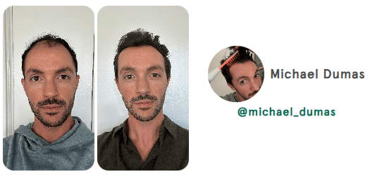 hair loss hair loss reversal natural hair loss reversal receding hair line hair growth natural hair growth hair growth remedy hair loss treatment nutrafol for women hair growth serum nutrafol for men alopecia areata alopecia hair regrowth for men rogaine for women rogaine for men best hair loss treatment hair growth shampoo keeps hair loss hims hair shampoo for hair loss beard growth dht blocker hair loss in women hair regrowth hair loss treatment for men hair doctor near me hair restoration near me hair regrowth for women best hair growth serum beard roller best shampoo for hair loss viviscal pro hair loss treatment for women hair specialist near me hair fall treatment hims hair growth best hair regrowth for men hair growth treatment thinning hair women best shampoo for hair growth vegamour hair serum hims hair loss nutrafol hair growth trichologist near me viviscal hair growth allurium hair growth serum thinning hair vegamour gro hair serum keranique hair regrowth treatment best hair loss treatment for female receding hairline postpartum hair loss hair growth for men hair clinic near me nutrafol hair hair implants for women bondi boost shampoo roman hair loss best hair regrowth for women hair regrowth treatment hair thinning treatment best hair loss treatment for male hair treatment for hair loss regrow hair naturally in 3 weeks best shampoo for hair loss female hair growth for women trichologist hair growth serum for women for hims hair capillus laser cap receding hairline treatment keeps hair treatment dermatologist recommended shampoo for hair loss hair loss prevention hair specialist doctor near me nutrafol women's balance hair transplant for women hair specialist nourishvita hair best shampoo for hair fall bondi boost hair growth female hair loss treatment mens hair loss hair falling out dermatologist hair loss specialist near me hair loss specialist near me best hair loss treatment for men hairfall solution hairmax laserband best hair serum for hair growth thinning hair men hair replacement for women moerie hair growth female hair loss hair fall control telogen effluvium best hair loss treatment for women hair loss doctor near me best hair growth male pattern baldness hair loss shampoo for men best hair regrowth treatment keeps hair loss treatment viviscal for women hair regrowth shampoo keranique hair regrowth hair loss clinic near me hair restoration for men keeps hair growth hair serum for hair growth hair loss cure hair loss serum laser cap for hair growth hair loss treatment near me male hair loss treatment kiierr laser cap hims hair regrowth treatment viviscal hair hair regrowth serum natural hair growth products hair loss clinic stop hair loss moerie hair shampoo for hair loss women viviscal shampoo hair loss doctor grow gorgeous hair growth serum hair growth treatment for women nutrafol for hair growth male pattern baldness treatment dermatologist for hair loss near me receding hairline men beard growth serum nutrafol hair growth serum hair growth treatment for men itchy scalp and hair loss vegamour hair growth serum hair treatment for men hair restoration for women dht blocker for women folexin hers hair growth keranique hair regrowth treatment for women hers hair regrowth treatment him hair loss best serum for hair growth and thickness bosley hair loss best hair growth for men best hair growth for women spectral dnc grow hair fast hair thinning treatment female laser hair growth hair growth serum for men neofollics shampoo hair plugs for women best treatment for thinning hair female best hair growth serum for women hair growth shampoo for men nutrafol hair growth supplement scalpmed for women spectral dnc n balding treatment nutrafol growth activator revivogen hims finasteride revivagen nutrifol for hims forhims topical finasteride finasteride 1mg finasteride for hair loss hims and hers buy finasteride finasteride tablets finasteride prescription hims finasteride finasteride 5mg 4hims oral finasteride finasteride online keeps finasteride finasteride pills buy finasteride online roman finasteride order finasteride hims sign in hims topical finasteride keeps topical finasteride cheapest finasteride propecia online finasteride for sale get finasteride prescription online finasteride cost finasteride for women order hims online order finasteride online finasteride hims hims products topical finasteride buy finasteride propecia generic finasteride finasteride hair growth finasteride over the counter finasteride online pharmacy best topical finasteride hims website bosley finasteride finasteride 1mg tablets buy propecia goodrx finasteride finasteride price happy head topical finasteride finasteride amazon hims hers buy topical finasteride finasteride keeps order propecia online get finasteride prescription hims finasteride cost get finasteride nutrifol men revivogen shampoo finasteride without prescription finasteride pills for hair loss finasteride 1mg amazon hims & hers cheapest finasteride online gethims finasteride hair cheapest way to get finasteride just for hims hims and hers health finasteride for men buy finasteride 1mg nutrifol for men finasteride hair regrowth get finasteride online xyon topical finasteride finasteride no prescription nutrifol for women order propecia finasteride 1mg price hims finasteride price finasteride goodrx hims for her buy finasteride 5mg topical finasteride amazon finasteride near me for hims sign in buy finasteride amazon finasteride cvs topical finasteride prescription topical fin for hims finasteride hims online cheapest topical finasteride buy finasteride for hair loss finasteride purchase finasteride roman numan finasteride 5mg finasteride best finasteride for hair loss roman topical finasteride hers and hims finasteride pharmacy best finasteride hims promo topical finasteride only finasteride for women's hair loss him finasteride finasteride 1mg online hims thick fix topical finasteride cost happy head finasteride topical finasteride for sale nutrifol women topical finasteride keeps hims official website hims and hers website hims men roman finasteride cost lemonaid finasteride for hims products oral finasteride for hair loss finasteride rx hims treatment www forhims hers hims finasteride walgreens finasteride medication finasteride receding hairline nutrifol reviews liposomal finasteride propecia finasteride 1mg hims health finasteride 5mg tablets topical finasteride for hair loss finasteride for sale online propecia prescription online hair loss tablets finasteride nutrifol shampoo hims amazon hims usa topical finasteride for women hair loss treatment finasteride finasteride for hair loss in female hims for women finasteride without doctor finasteride hairline topical finasteride online for hims topical finasteride topical finasteride hims finasteride for receding hairline buy finasteride tablets finasteride 0.5 mg finasteride how to get topical finasteride buy online finasteride prescription cost hims for hair forhims finasteride hims near me finasteride topical for hair loss finasteride cost per month finasteride hair treatment hims target sons finasteride finasteride and dutasteride finasteride reddit finasteride treatment finasteride for hair loss female finasteride 1mg prescription rogaine and finasteride liposomal topical finasteride finasteride 1mg for hair loss finasteride products finasteride 5mg price accord finasteride hims store finasteride discount propecia over the counter hims for sale cheapest finasteride 1mg hims healthcare revivogen md forhi cvs finasteride finasteride uses finasteride 6 months pharmica finasteride hims topical finasteride cost propecia hair growth blink health finasteride propecia buy online propecia price hims & hers health topical finasteride price male pattern baldness female pattern baldness alopecia hair loss treatment alopecia areata hair loss best hair loss treatment hair loss in women hair loss treatment for men hair loss treatment for women hair fall treatment hims hair loss best hair loss treatment for female best hair loss treatment for male hair treatment for hair loss hair loss prevention female hair loss treatment mens hair loss hair falling out hair loss specialist near me best hair loss treatment for men female hair loss hair fall control best hair loss treatment for women hair loss doctor near me hair loss clinic near me my hair is falling out hair loss cure hair loss treatment near me red light therapy for hair loss male hair loss treatment hair fall solution hair loss clinic stop hair loss hair loss doctor male pattern baldness treatment hair loss causes itchy scalp and hair loss him hair loss hair thinning treatment female balding treatment topical hair loss treatment hair fall hair loss after pregnancy hair loss prevention men hair loss specialist androgenic alopecia causes of hair loss in women alopecia areata causes hair fall doctor near me male hair loss hair loss solutions best hair treatment for hair loss olumiant for hair loss hair loss surgery hair thinning at front female alopecia areata self care hair loss solutions for men hair loss remedies best hair loss treatment for female home remedy reverse hair loss anti hair loss reasons for hair loss in women hair fall treatment near me bald spot on head bald spot treatment scalp treatment for hair loss hair thinning treatment male nioxin hair loss new hair loss treatment natural remedies for hair loss light therapy for hair loss olaplex hair loss my hair is thinning female male baldness treatment most effective hair loss treatment for hims hair loss hair fall treatment for women reasons for hair loss female pattern hair loss natural hair loss treatment pcos hair loss hair fall reasons in female best hair fall treatment keep hair loss female hair loss specialist near me hair loss help olumiant hair loss hair balding treatment best for hair loss stop hair loss women dermaroller for hair loss sudden hair loss in women dht hair loss stop hair loss men best thing for hair loss hair loss solutions for women hair transplant hair transplant cost hair transplant near me hair restoration hair restoration near me fue hair transplant hair implants hair replacement for men hair clinic near me hair implants for women hair plugs smile hair clinic hair implants for men cost beard transplant turkish hair transplant advanced hair restoration cost dhi hair transplant bosley hair transplant cost hair implants for men eyebrow transplant hair transplant for women hair replacement hair clinic hairline transplant hairline surgery fue hair transplant cost hair surgery best hair transplant hair replacement for women hairline restoration hermest hair clinic hair plugs cost hair transplant surgery hair plugs for men hair restoration for men hair implants near me hair transplant price hair restoration surgery hair replacement near me eyebrow hair transplant hair transplant consultation beard transplant cost mens hair transplant hair restoration for women fue hair transplant near me best hair transplant in the world bosley hair restoration cost hair plugs for women neograft hair transplant hair plantation cost non surgical hair replacement hairline transplant cost beard implants best hair restoration best hair doctor near me turkish hair transplant cost fut hair transplant stem cell hair transplant hair transplant clinic near me female hair transplant restore hair cost hairline lowering surgery hair follicle transplant cheap hair transplant hair plantation bosley hair replacement beard transplant near me hair implant cost hair restoration cost hair transplant clinic hair loss surgery 5000 grafts hair transplant cost eyebrow transplant near me hair surgery near me best hair transplant near me non surgical hair replacement near me eyebrow implants best place for hair transplant hair replacement surgery affordable hair transplant hair replacement for men near me beard hair transplant robotic hair transplant hair graft eyebrow transplant cost hair plantation near me neograft facial hair transplant hair implants for men near me average cost of hair transplant eyebrow grafting hair transplant procedure sule hair transplant cheap hair transplant near me female hair transplant cost hair transplant after 10 years hair growth surgery hair transplant without shaving best hair clinic near me hair plugs near me dr cinik hair transplant male hair transplant rob holding hair transplant bosley hair restoration & transplant bosley hair clinic fue hair asli tarcan hair clinic crown hair transplant bosley cost hair plant sule hair hair transplant doctors near me hairline restoration cost fue near me best hair restoration near me men's hair restoration near me hermest hair transplant stem cell hair restoration men's hair replacement near me fue cost hair transplant cost near me mens hair transplant near me dhi hair transplant cost advanced hair cost bosley hair cost facial hair implants best place to get hair transplant now hairtime hair restoration treatment bosley hair treatment cost serkan aygin clinic laser hair restoration eyebrow restoration natural transplants hair restoration clinic hairtransplant turkey hair transplant hairline 2000 grafts hair transplant cost best hair replacement hair grafting near me best turkish hair transplant medical hair centre yaker hair restoration hair loss clinics near me afro hair transplant fue transplant cost women's hair transplant cost cinik hair transplant tj hair clinic best hair transplant clinic in the world beard surgery hair transplant for receding hairline hair replacement cost surgical hair restoration male hair transplant cost hair graft cost rara hair transplant keeps hair restoration vera clinic hair transplant cost hair loss clinics beard implants near me robotic hair restoration black hair transplant artificial hair transplant fue transplant near me synthetic hair transplant hair transplant for black males fut hair transplant cost hair transplant options sapphire fue hair transplant dr brett bolton hair loss restoration robotic hair transplant cost dr leonard hair medaway hair transplant non surgical hair restoration hair restoration clinic direct hair implantation african american hair transplant eyebrow implants near me best hair transplant clinic vera clinic hair transplant restore hair transplant neograft hair transplant near me hair replacement for men cost hair implant surgery hair follicle surgery eyebrow hair transplant near me non surgical hair transplant follicular unit transplantation varona hair restoration biofibre hair transplant mens hair transplant cost sapphire hair clinic eyebrow hair transplant cost neograft hair transplant cost beard implants price natural hair transplant