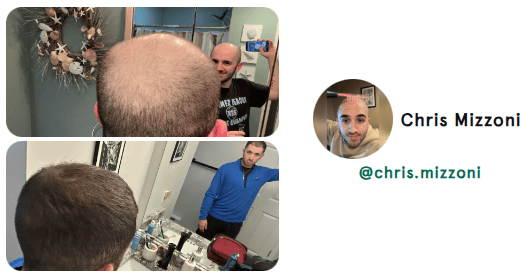 hair loss hair loss reversal natural hair loss reversal receding hair line hair growth natural hair growth hair growth remedy hair loss treatment nutrafol for women hair growth serum nutrafol for men alopecia areata alopecia hair regrowth for men rogaine for women rogaine for men best hair loss treatment hair growth shampoo keeps hair loss hims hair shampoo for hair loss beard growth dht blocker hair loss in women hair regrowth hair loss treatment for men hair doctor near me hair restoration near me hair regrowth for women best hair growth serum beard roller best shampoo for hair loss viviscal pro hair loss treatment for women hair specialist near me hair fall treatment hims hair growth best hair regrowth for men hair growth treatment thinning hair women best shampoo for hair growth vegamour hair serum hims hair loss nutrafol hair growth trichologist near me viviscal hair growth allurium hair growth serum thinning hair vegamour gro hair serum keranique hair regrowth treatment best hair loss treatment for female receding hairline postpartum hair loss hair growth for men hair clinic near me nutrafol hair hair implants for women bondi boost shampoo roman hair loss best hair regrowth for women hair regrowth treatment hair thinning treatment best hair loss treatment for male hair treatment for hair loss regrow hair naturally in 3 weeks best shampoo for hair loss female hair growth for women trichologist hair growth serum for women for hims hair capillus laser cap receding hairline treatment keeps hair treatment dermatologist recommended shampoo for hair loss hair loss prevention hair specialist doctor near me nutrafol women's balance hair transplant for women hair specialist nourishvita hair best shampoo for hair fall bondi boost hair growth female hair loss treatment mens hair loss hair falling out dermatologist hair loss specialist near me hair loss specialist near me best hair loss treatment for men hairfall solution hairmax laserband best hair serum for hair growth thinning hair men hair replacement for women moerie hair growth female hair loss hair fall control telogen effluvium best hair loss treatment for women hair loss doctor near me best hair growth male pattern baldness hair loss shampoo for men best hair regrowth treatment keeps hair loss treatment viviscal for women hair regrowth shampoo keranique hair regrowth hair loss clinic near me hair restoration for men keeps hair growth hair serum for hair growth hair loss cure hair loss serum laser cap for hair growth hair loss treatment near me male hair loss treatment kiierr laser cap hims hair regrowth treatment viviscal hair hair regrowth serum natural hair growth products hair loss clinic stop hair loss moerie hair shampoo for hair loss women viviscal shampoo hair loss doctor grow gorgeous hair growth serum hair growth treatment for women nutrafol for hair growth male pattern baldness treatment dermatologist for hair loss near me receding hairline men beard growth serum nutrafol hair growth serum hair growth treatment for men itchy scalp and hair loss vegamour hair growth serum hair treatment for men hair restoration for women dht blocker for women folexin hers hair growth keranique hair regrowth treatment for women hers hair regrowth treatment him hair loss best serum for hair growth and thickness bosley hair loss best hair growth for men best hair growth for women spectral dnc grow hair fast hair thinning treatment female laser hair growth hair growth serum for men neofollics shampoo hair plugs for women best treatment for thinning hair female best hair growth serum for women hair growth shampoo for men nutrafol hair growth supplement scalpmed for women spectral dnc n balding treatment nutrafol growth activator revivogen hims finasteride revivagen nutrifol for hims forhims topical finasteride finasteride 1mg finasteride for hair loss hims and hers buy finasteride finasteride tablets finasteride prescription hims finasteride finasteride 5mg 4hims oral finasteride finasteride online keeps finasteride finasteride pills buy finasteride online roman finasteride order finasteride hims sign in hims topical finasteride keeps topical finasteride cheapest finasteride propecia online finasteride for sale get finasteride prescription online finasteride cost finasteride for women order hims online order finasteride online finasteride hims hims products topical finasteride buy finasteride propecia generic finasteride finasteride hair growth finasteride over the counter finasteride online pharmacy best topical finasteride hims website bosley finasteride finasteride 1mg tablets buy propecia goodrx finasteride finasteride price happy head topical finasteride finasteride amazon hims hers buy topical finasteride finasteride keeps order propecia online get finasteride prescription hims finasteride cost get finasteride nutrifol men revivogen shampoo finasteride without prescription finasteride pills for hair loss finasteride 1mg amazon hims & hers cheapest finasteride online gethims finasteride hair cheapest way to get finasteride just for hims hims and hers health finasteride for men buy finasteride 1mg nutrifol for men finasteride hair regrowth get finasteride online xyon topical finasteride finasteride no prescription nutrifol for women order propecia finasteride 1mg price hims finasteride price finasteride goodrx hims for her buy finasteride 5mg topical finasteride amazon finasteride near me for hims sign in buy finasteride amazon finasteride cvs topical finasteride prescription topical fin for hims finasteride hims online cheapest topical finasteride buy finasteride for hair loss finasteride purchase finasteride roman numan finasteride 5mg finasteride best finasteride for hair loss roman topical finasteride hers and hims finasteride pharmacy best finasteride hims promo topical finasteride only finasteride for women's hair loss him finasteride finasteride 1mg online hims thick fix topical finasteride cost happy head finasteride topical finasteride for sale nutrifol women topical finasteride keeps hims official website hims and hers website hims men roman finasteride cost lemonaid finasteride for hims products oral finasteride for hair loss finasteride rx hims treatment www forhims hers hims finasteride walgreens finasteride medication finasteride receding hairline nutrifol reviews liposomal finasteride propecia finasteride 1mg hims health finasteride 5mg tablets topical finasteride for hair loss finasteride for sale online propecia prescription online hair loss tablets finasteride nutrifol shampoo hims amazon hims usa topical finasteride for women hair loss treatment finasteride finasteride for hair loss in female hims for women finasteride without doctor finasteride hairline topical finasteride online for hims topical finasteride topical finasteride hims finasteride for receding hairline buy finasteride tablets finasteride 0.5 mg finasteride how to get topical finasteride buy online finasteride prescription cost hims for hair forhims finasteride hims near me finasteride topical for hair loss finasteride cost per month finasteride hair treatment hims target sons finasteride finasteride and dutasteride finasteride reddit finasteride treatment finasteride for hair loss female finasteride 1mg prescription rogaine and finasteride liposomal topical finasteride finasteride 1mg for hair loss finasteride products finasteride 5mg price accord finasteride hims store finasteride discount propecia over the counter hims for sale cheapest finasteride 1mg hims healthcare revivogen md forhi cvs finasteride finasteride uses finasteride 6 months pharmica finasteride hims topical finasteride cost propecia hair growth blink health finasteride propecia buy online propecia price hims & hers health topical finasteride price male pattern baldness female pattern baldness alopecia hair loss treatment alopecia areata hair loss best hair loss treatment hair loss in women hair loss treatment for men hair loss treatment for women hair fall treatment hims hair loss best hair loss treatment for female best hair loss treatment for male hair treatment for hair loss hair loss prevention female hair loss treatment mens hair loss hair falling out hair loss specialist near me best hair loss treatment for men female hair loss hair fall control best hair loss treatment for women hair loss doctor near me hair loss clinic near me my hair is falling out hair loss cure hair loss treatment near me red light therapy for hair loss male hair loss treatment hair fall solution hair loss clinic stop hair loss hair loss doctor male pattern baldness treatment hair loss causes itchy scalp and hair loss him hair loss hair thinning treatment female balding treatment topical hair loss treatment hair fall hair loss after pregnancy hair loss prevention men hair loss specialist androgenic alopecia causes of hair loss in women alopecia areata causes hair fall doctor near me male hair loss hair loss solutions best hair treatment for hair loss olumiant for hair loss hair loss surgery hair thinning at front female alopecia areata self care hair loss solutions for men hair loss remedies best hair loss treatment for female home remedy reverse hair loss anti hair loss reasons for hair loss in women hair fall treatment near me bald spot on head bald spot treatment scalp treatment for hair loss hair thinning treatment male nioxin hair loss new hair loss treatment natural remedies for hair loss light therapy for hair loss olaplex hair loss my hair is thinning female male baldness treatment most effective hair loss treatment for hims hair loss hair fall treatment for women reasons for hair loss female pattern hair loss natural hair loss treatment pcos hair loss hair fall reasons in female best hair fall treatment keep hair loss female hair loss specialist near me hair loss help olumiant hair loss hair balding treatment best for hair loss stop hair loss women dermaroller for hair loss sudden hair loss in women dht hair loss stop hair loss men best thing for hair loss hair loss solutions for women hair transplant hair transplant cost hair transplant near me hair restoration hair restoration near me fue hair transplant hair implants hair replacement for men hair clinic near me hair implants for women hair plugs smile hair clinic hair implants for men cost beard transplant turkish hair transplant advanced hair restoration cost dhi hair transplant bosley hair transplant cost hair implants for men eyebrow transplant hair transplant for women hair replacement hair clinic hairline transplant hairline surgery fue hair transplant cost hair surgery best hair transplant hair replacement for women hairline restoration hermest hair clinic hair plugs cost hair transplant surgery hair plugs for men hair restoration for men hair implants near me hair transplant price hair restoration surgery hair replacement near me eyebrow hair transplant hair transplant consultation beard transplant cost mens hair transplant hair restoration for women fue hair transplant near me best hair transplant in the world bosley hair restoration cost hair plugs for women neograft hair transplant hair plantation cost non surgical hair replacement hairline transplant cost beard implants best hair restoration best hair doctor near me turkish hair transplant cost fut hair transplant stem cell hair transplant hair transplant clinic near me female hair transplant restore hair cost hairline lowering surgery hair follicle transplant cheap hair transplant hair plantation bosley hair replacement beard transplant near me hair implant cost hair restoration cost hair transplant clinic hair loss surgery 5000 grafts hair transplant cost eyebrow transplant near me hair surgery near me best hair transplant near me non surgical hair replacement near me eyebrow implants best place for hair transplant hair replacement surgery affordable hair transplant hair replacement for men near me beard hair transplant robotic hair transplant hair graft eyebrow transplant cost hair plantation near me neograft facial hair transplant hair implants for men near me average cost of hair transplant eyebrow grafting hair transplant procedure sule hair transplant cheap hair transplant near me female hair transplant cost hair transplant after 10 years hair growth surgery hair transplant without shaving best hair clinic near me hair plugs near me dr cinik hair transplant male hair transplant rob holding hair transplant bosley hair restoration & transplant bosley hair clinic fue hair asli tarcan hair clinic crown hair transplant bosley cost hair plant sule hair hair transplant doctors near me hairline restoration cost fue near me best hair restoration near me men's hair restoration near me hermest hair transplant stem cell hair restoration men's hair replacement near me fue cost hair transplant cost near me mens hair transplant near me dhi hair transplant cost advanced hair cost bosley hair cost facial hair implants best place to get hair transplant now hairtime hair restoration treatment bosley hair treatment cost serkan aygin clinic laser hair restoration eyebrow restoration natural transplants hair restoration clinic hairtransplant turkey hair transplant hairline 2000 grafts hair transplant cost best hair replacement hair grafting near me best turkish hair transplant medical hair centre yaker hair restoration hair loss clinics near me afro hair transplant fue transplant cost women's hair transplant cost cinik hair transplant tj hair clinic best hair transplant clinic in the world beard surgery hair transplant for receding hairline hair replacement cost surgical hair restoration male hair transplant cost hair graft cost rara hair transplant keeps hair restoration vera clinic hair transplant cost hair loss clinics beard implants near me robotic hair restoration black hair transplant artificial hair transplant fue transplant near me synthetic hair transplant hair transplant for black males fut hair transplant cost hair transplant options sapphire fue hair transplant dr brett bolton hair loss restoration robotic hair transplant cost dr leonard hair medaway hair transplant non surgical hair restoration hair restoration clinic direct hair implantation african american hair transplant eyebrow implants near me best hair transplant clinic vera clinic hair transplant restore hair transplant neograft hair transplant near me hair replacement for men cost hair implant surgery hair follicle surgery eyebrow hair transplant near me non surgical hair transplant follicular unit transplantation varona hair restoration biofibre hair transplant mens hair transplant cost sapphire hair clinic eyebrow hair transplant cost neograft hair transplant cost beard implants price natural hair transplant